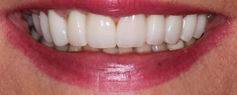 After photograph, Crowns and veneers case 1 of 33, published by Berry Farms Dental