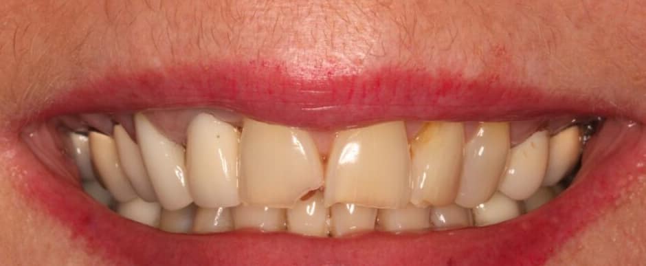 Before photograph, Crowns and veneers case 1 of 33, published by Berry Farms Dental