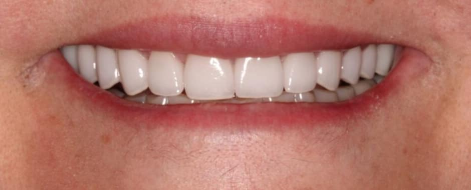 After photograph, Crowns and veneers case 2 of 33, published by Berry Farms Dental