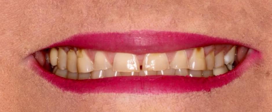Before photograph, Crowns and veneers case 2 of 33, published by Berry Farms Dental