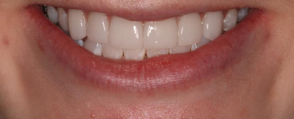 After photograph, Crowns and veneers case 3 of 33, published by Berry Farms Dental