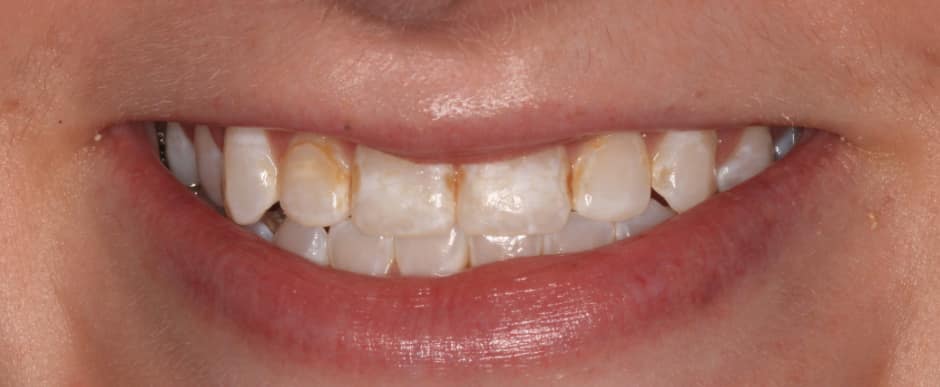 Before photograph, Crowns and veneers case 3 of 33, published by Berry Farms Dental