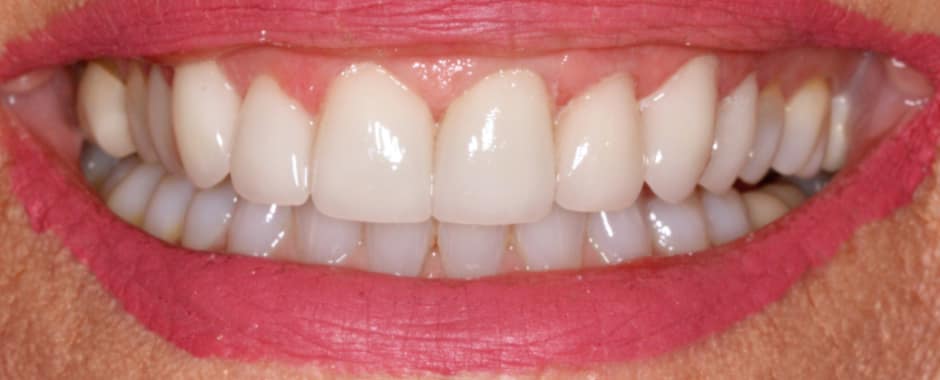 After photograph, Crowns and veneers case 4 of 33, published by Berry Farms Dental