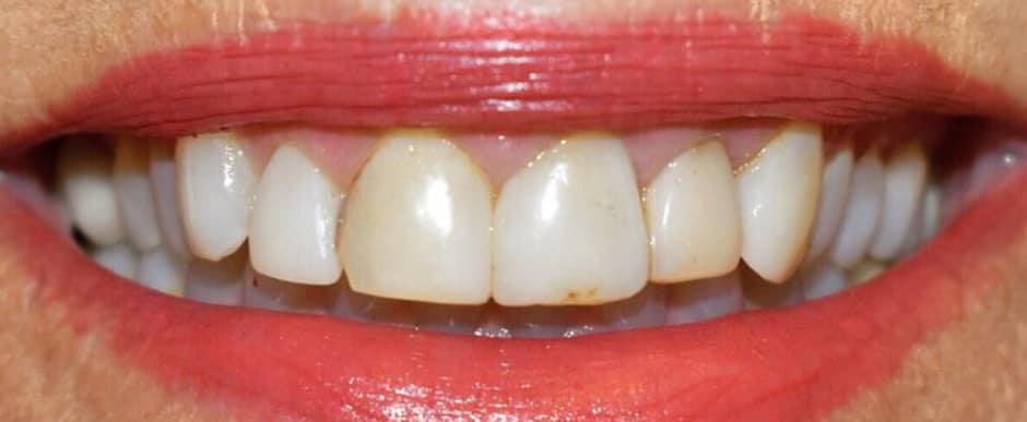 Before photograph, Crowns and veneers case 4 of 33, published by Berry Farms Dental