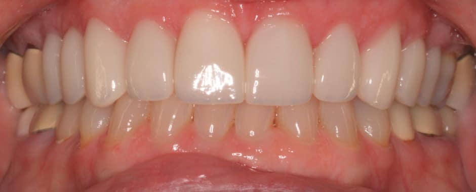 After photograph, Crowns and veneers case 5 of 33, published by Berry Farms Dental