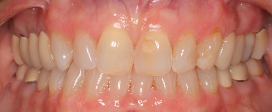 Before photograph, Crowns and veneers case 5 of 33, published by Berry Farms Dental