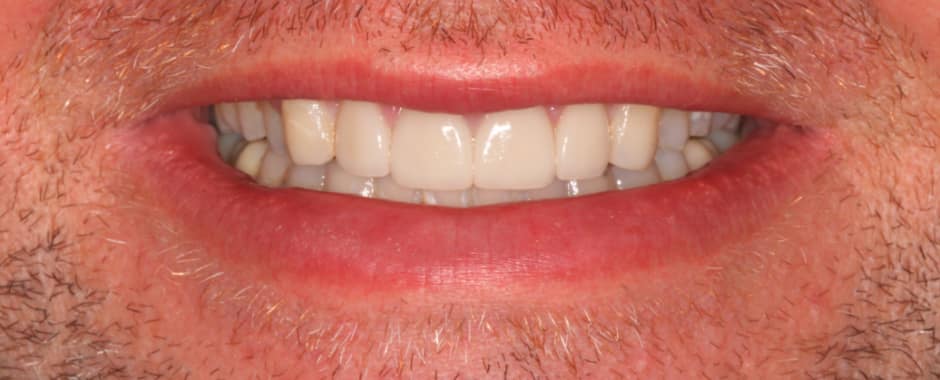 After photograph, Crowns and veneers case 6 of 33, published by Berry Farms Dental