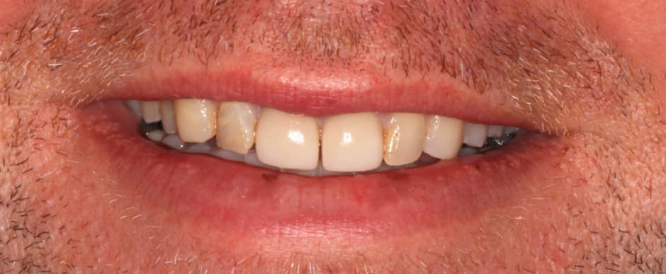Before photograph, Crowns and veneers case 6 of 33, published by Berry Farms Dental