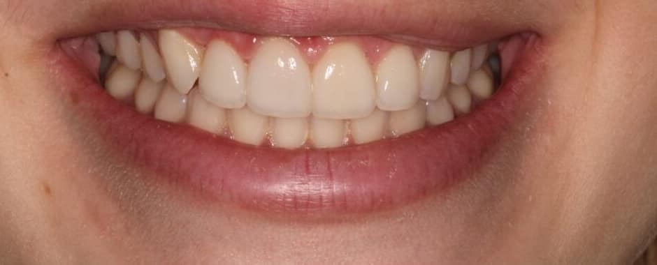 After photograph, Crowns and veneers case 7 of 33, published by Berry Farms Dental