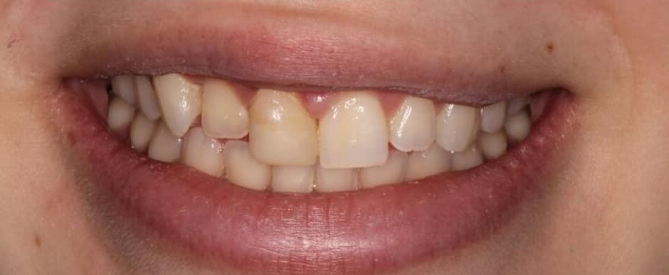 Before photograph, Crowns and veneers case 7 of 33, published by Berry Farms Dental
