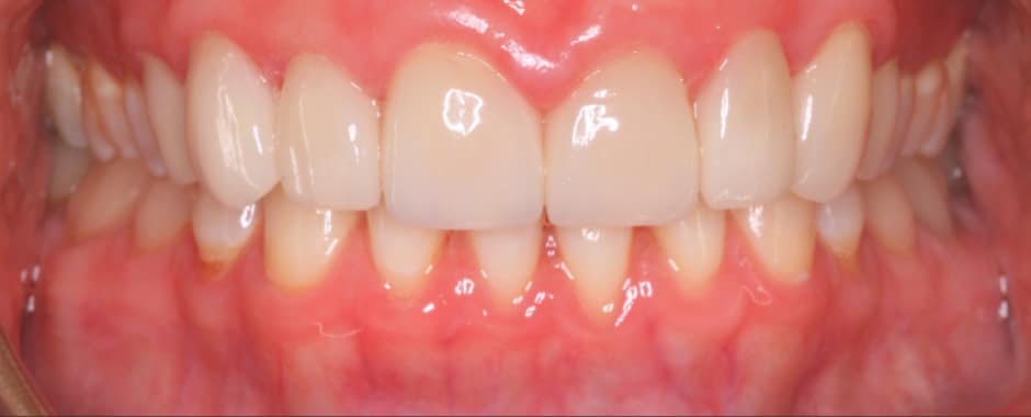 After photograph, Crowns and veneers case 8 of 33, published by Berry Farms Dental