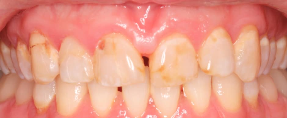 Before photograph, Crowns and veneers case 8 of 33, published by Berry Farms Dental