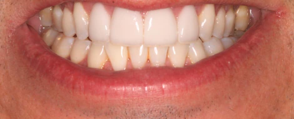 After photograph, Crowns and veneers case 9 of 33, published by Berry Farms Dental
