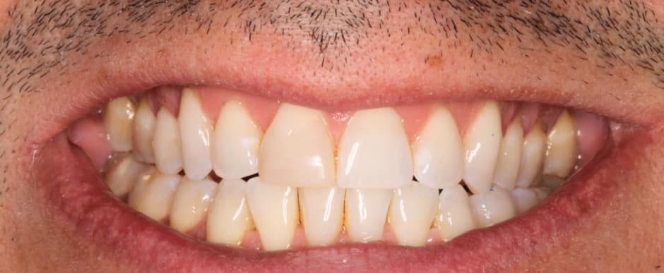 Before photograph, Crowns and veneers case 9 of 33, published by Berry Farms Dental