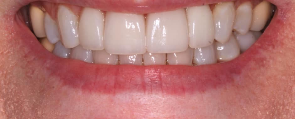 After photograph, Crowns and veneers case 10 of 33, published by Berry Farms Dental