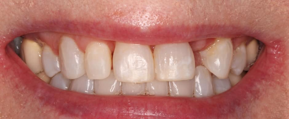 Before photograph, Crowns and veneers case 10 of 33, published by Berry Farms Dental