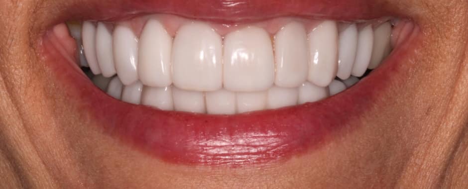 After photograph, Crowns and veneers case 11 of 33, published by Berry Farms Dental
