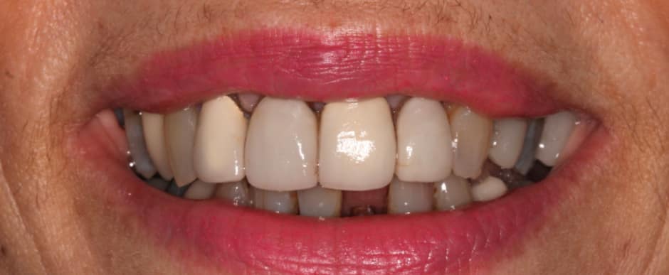 Before photograph, Crowns and veneers case 11 of 33, published by Berry Farms Dental