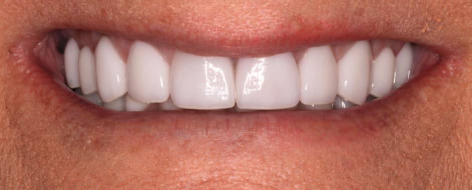 After photograph, Crowns and veneers case 12 of 33, published by Berry Farms Dental