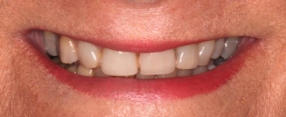 Before photograph, Crowns and veneers case 12 of 33, published by Berry Farms Dental