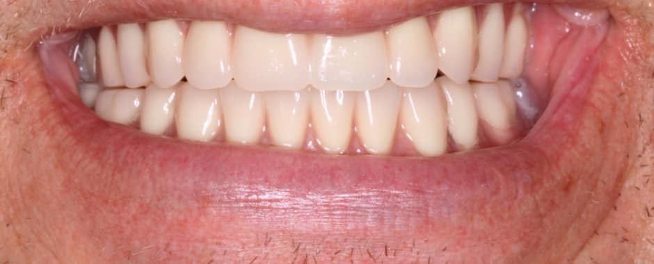 After photograph, Implant-supported full arch case 13 of 33, published by Berry Farms Dental