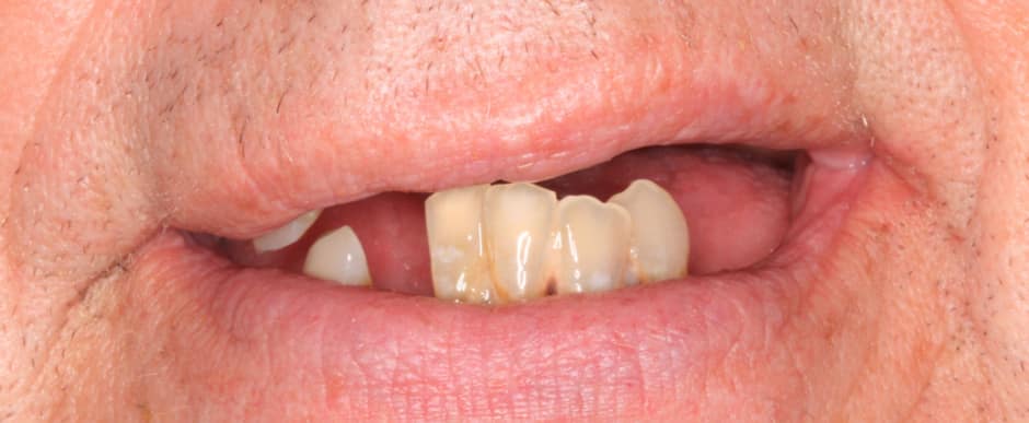 Before photograph, Implant-supported full arch case 13 of 33, published by Berry Farms Dental