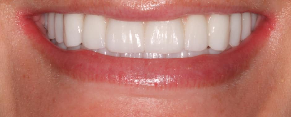 After photograph, Implant-supported full arch case 14 of 33, published by Berry Farms Dental