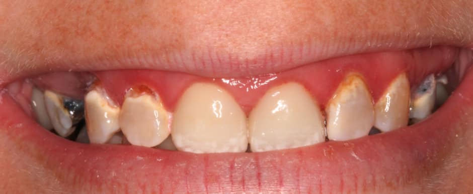 Before photograph, Implant-supported full arch case 14 of 33, published by Berry Farms Dental