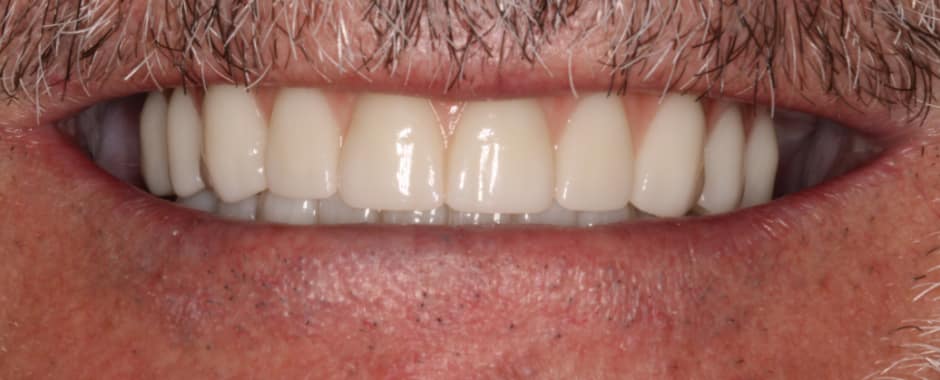 After photograph, Implant-supported full arch case 15 of 33, published by Berry Farms Dental