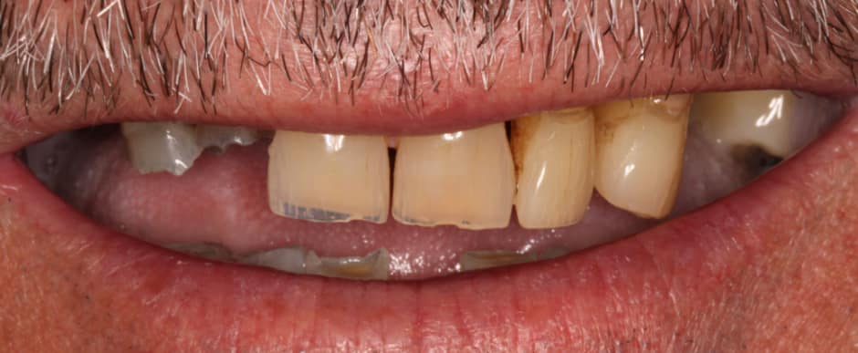 Before photograph, Implant-supported full arch case 15 of 33, published by Berry Farms Dental