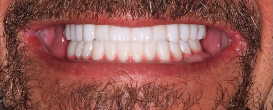 After photograph, Implant-supported full arch case 16 of 33, published by Berry Farms Dental