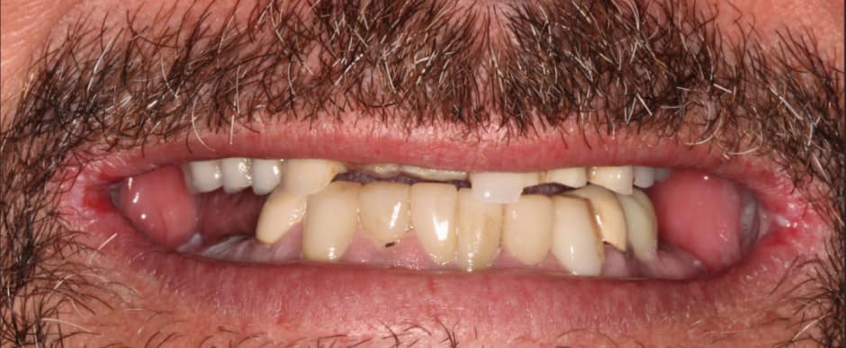 Before photograph, Implant-supported full arch case 16 of 33, published by Berry Farms Dental