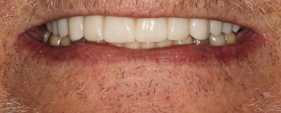 After photograph, Implant-supported full arch case 17 of 33, published by Berry Farms Dental