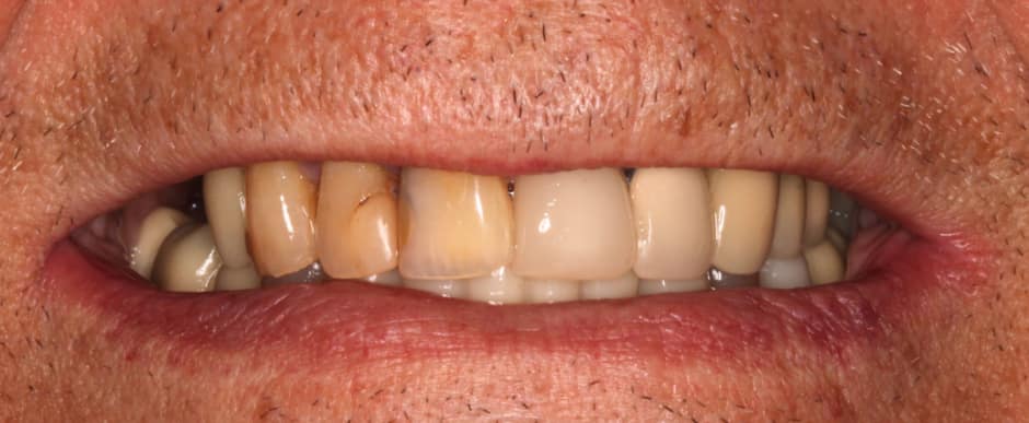 Before photograph, Implant-supported full arch case 17 of 33, published by Berry Farms Dental