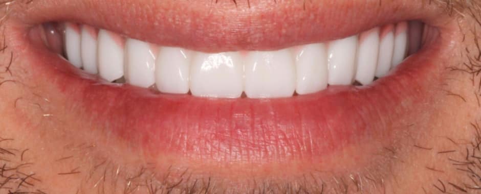 After photograph, Implant-supported full arch case 18 of 33, published by Berry Farms Dental