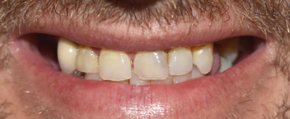 Before photograph, Implant-supported full arch case 18 of 33, published by Berry Farms Dental