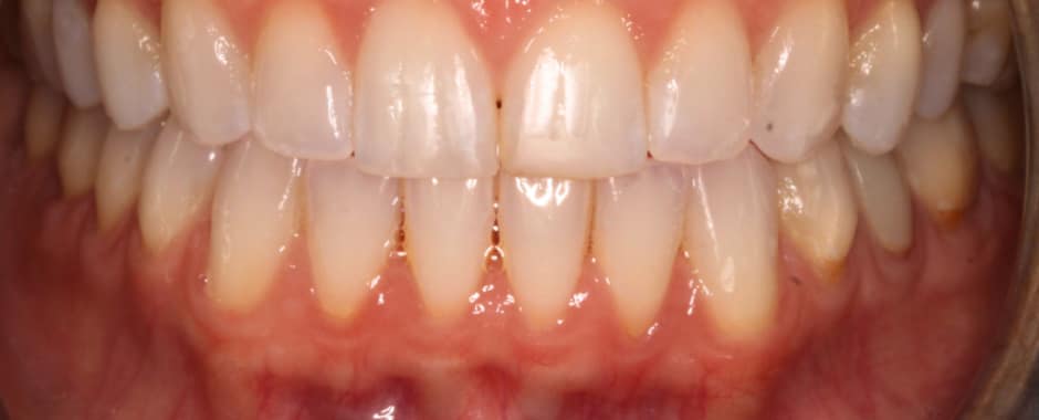 After photograph, Invisalign case 19 of 33, published by Berry Farms Dental