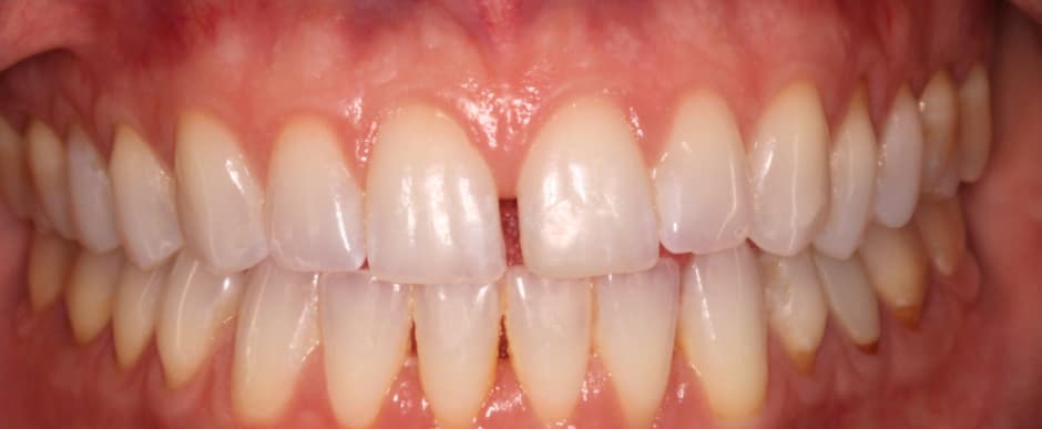 Before photograph, Invisalign case 19 of 33, published by Berry Farms Dental