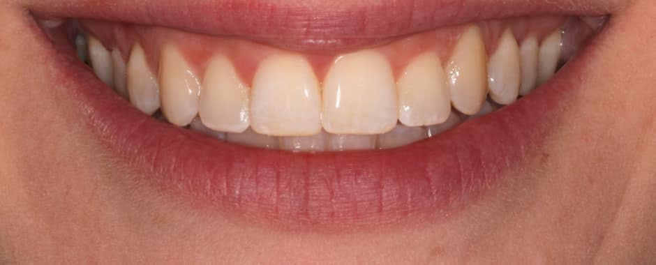 After photograph, Invisalign case 20 of 33, published by Berry Farms Dental