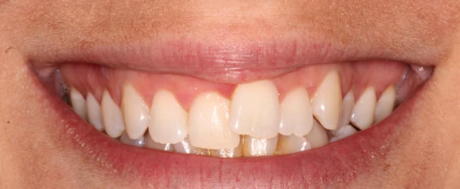 Before photograph, Invisalign case 20 of 33, published by Berry Farms Dental