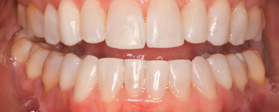 After photograph, Invisalign case 21 of 33, published by Berry Farms Dental