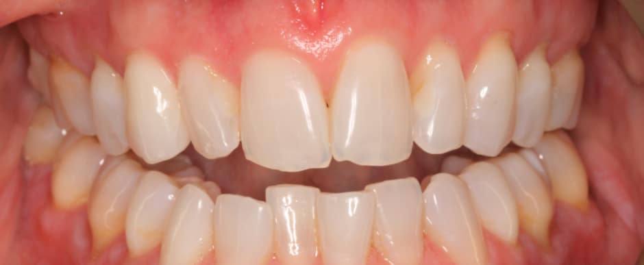 Before photograph, Invisalign case 21 of 33, published by Berry Farms Dental