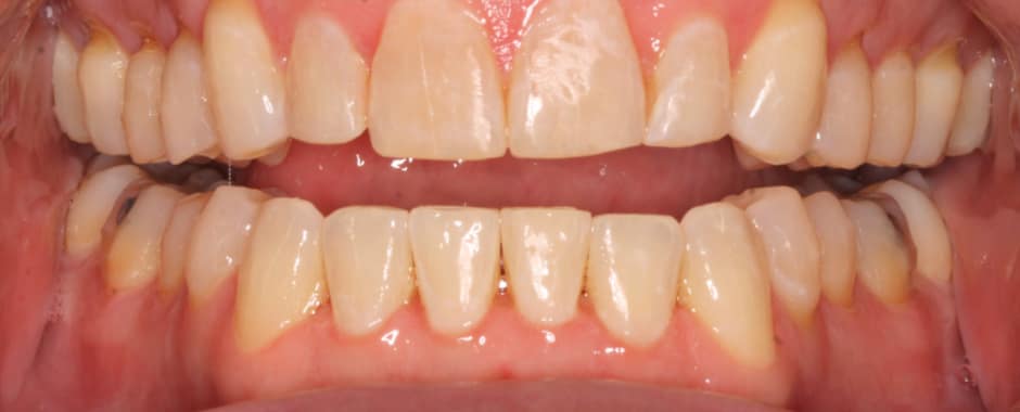 After photograph, Invisalign case 22 of 33, published by Berry Farms Dental