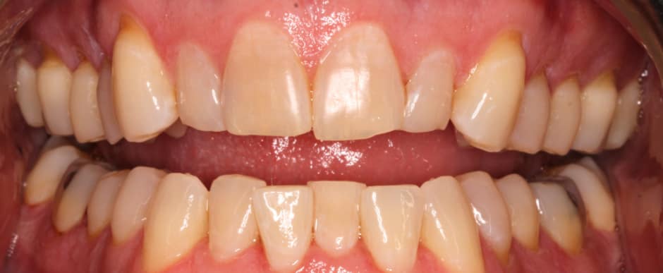 Before photograph, Invisalign case 22 of 33, published by Berry Farms Dental