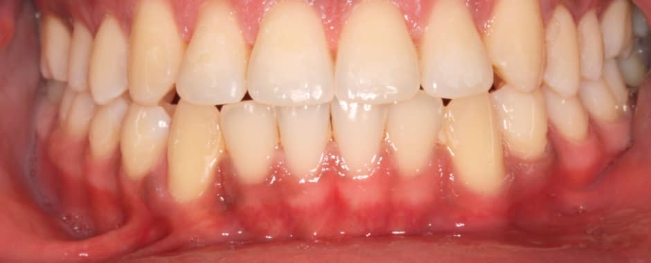 After photograph, Invisalign case 23 of 33, published by Berry Farms Dental
