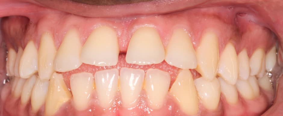 Before photograph, Invisalign case 23 of 33, published by Berry Farms Dental