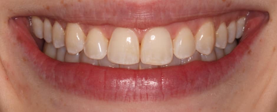 After photograph, Invisalign case 24 of 33, published by Berry Farms Dental