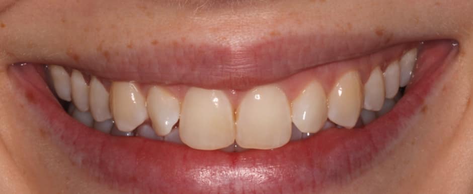 Before photograph, Invisalign case 24 of 33, published by Berry Farms Dental