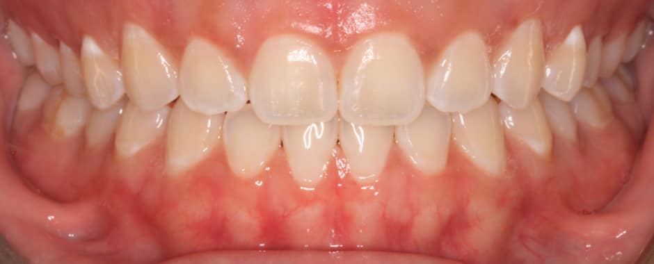 After photograph, Invisalign case 25 of 33, published by Berry Farms Dental