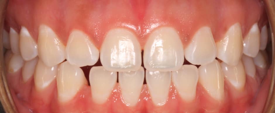 Before photograph, Invisalign case 25 of 33, published by Berry Farms Dental